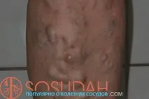 Тромбофлебіт фото, симптоми та ознаки недуги нижніх кінцівок, Хвороби судин та способи їх фото