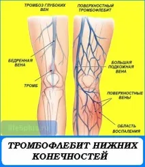 Тромбофлебіт нижній кінцівок причини, симптоми, народне лікування кінцівок