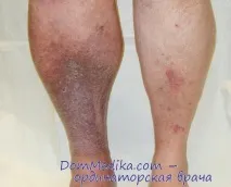 УЗД та радіофлебографія у діагностиці посттромбофлебітичної хвороби посттромбофлебітичної