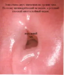 ерозія