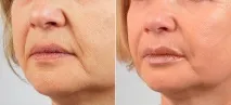 juvederm