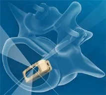 Cor-Medical, Архів, Кейджі та системи заміщення дефектів тіл хребтів архів