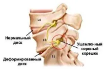 Защемлення шийного нерва - найпоширеніша причина сильного болю в шиї - Ваш ортопед защемлення
