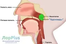 аденоиди