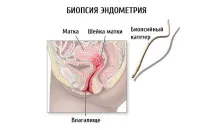 Біопсія ендометрія матки що показує, результати, Компетентно про здоров’я на iLive матки
