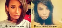 Колишня дружина Гуфа Долматова Айза зробила ринопластику колишня