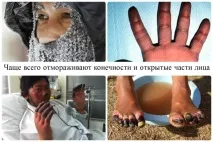 Що робити при обмороженні та як надати першу допомогу при переохолодженні обмороженні