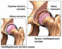 Деформуючий артроз гомілковостопного суглоба лікування захворювання та боротьба з ураженням інших суглоба