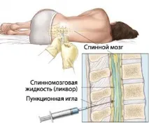 Для чого роблять пункцію спинного мозку пункцію