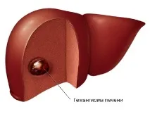 Гемангіома печінки виявлення захворювання, фактори розвитку, лікування фактори