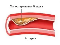 Як і чим швидко знизити холестерин без ліків у жінок та чоловіків швидко