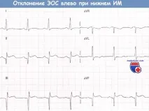 Шестиосьова система координат ЕКГ шестиосьова