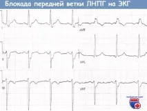 Шестиосьова система координат ЕКГ шестиосьова