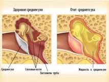 Краплі вушні Ципромед (інструкція із застосування) застосування