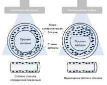 коронарна