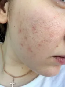 dermablend