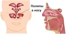 Кровотеча з носа 5 причин носа