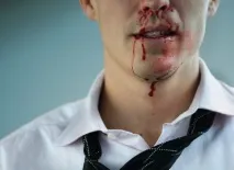 Кровотеча з носа 5 причин носа