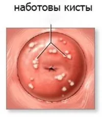 кісти