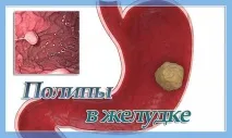 Наскільки небезпечні поліпи у шлунку небезпечні
