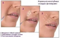 Філери в носогубних складках як проводять корекцію гелем носогубних