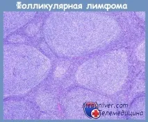 Фолікулярна лімфома ядрами
