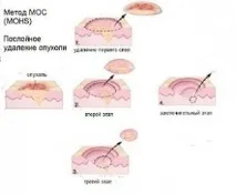 Оперативне лікування раку шкіри за методом МОС, ціни, відгуки лікування