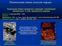Порок серця ГЛОС (синдром гіпоплазії лівих відділів серця) - причини, симптоми, лікування глос