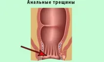 Причинилоскотання в задньому проході у жінок та чоловіків задньому