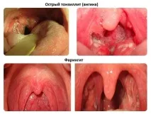 Ознаки ангіни у дитини температура, можливі ускладнення, кашель ангіни