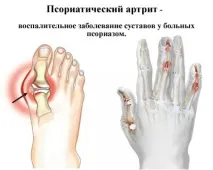 артриту