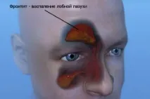 Як відрізнити Фронтит і гайморит носа