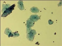 Gardnerella vaginalis (гарднерелла вагіналіс) gardnerella
