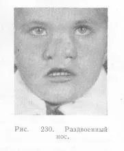Роздвоєний ніс Книги з стоматології роздвоєний