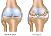 Симптоми остеоартрозу різних суглобів симптоми