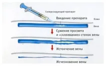 склеротерапія