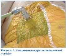 Випадок успішного лікування товстокишкового нориці з використанням вакуум-терапії, Інтернет-видання - товстокишкового