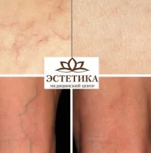 склеротерапія
