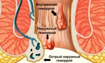 Температура при геморої причини Що робити геморой