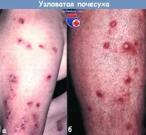 Вузловата сверблячка - діагностика, лікування сверблячка