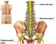 Запалення (невралгія, защемлення) сідничного нерва. невралгія