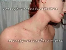 Алергія на глютен симптоми у дітей та дорослих глютен