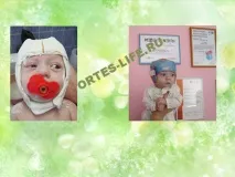Деформація черепа у дітей - Сайт ortes-life! дітей