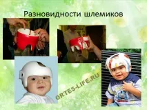 Деформація черепа у дітей - Сайт ortes-life! дітей