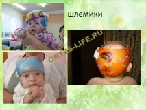 Деформація черепа у дітей - Сайт ortes-life! деформація