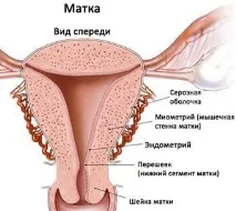 Гіпертрофія шийки матки матки