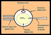 ІКСІ це що за процедура докладно (відео) процедура