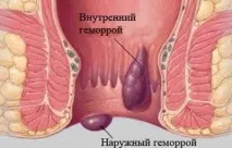Як знеболити геморой після пологів у домашніх умовах швидко знеболити