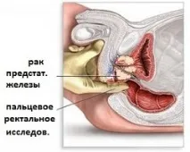 Як раціонально використовувати молоко простати для діагностики діагностики