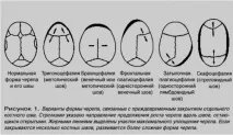 Корекція форми черепа у немовлят форми